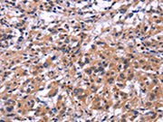 The image on the left is immunohistochemistry of paraffin-embedded Human thyroid cancer tissue using CSB-PA571675(SIGLEC5 Antibody) at dilution 1/30, on the right is treated with fusion protein. (Original magnification: ×200)