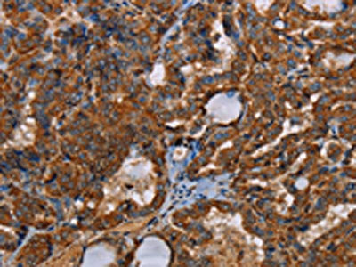 The image on the left is immunohistochemistry of paraffin-embedded Human thyroid cancer tissue using CSB-PA571782(POU6F2 Antibody) at dilution 1/30, on the right is treated with synthetic peptide. (Original magnification: ×200)