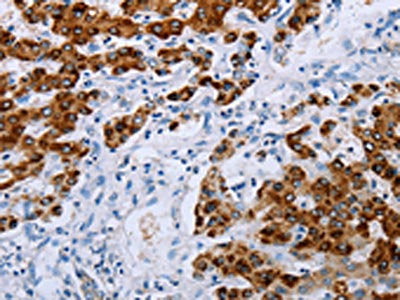 The image on the left is immunohistochemistry of paraffin-embedded Human liver cancer tissue using CSB-PA571870(NDUFA12 Antibody) at dilution 1/50, on the right is treated with synthetic peptide. (Original magnification: ×200)