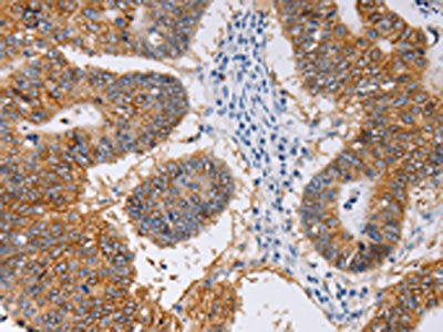The image on the left is immunohistochemistry of paraffin-embedded Human colon cancer tissue using CSB-PA571908(PIWIL1 Antibody) at dilution 1/30, on the right is treated with fusion protein. (Original magnification: ×200)