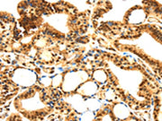 The image on the left is immunohistochemistry of paraffin-embedded Human thyroid cancer tissue using CSB-PA572039(SERPINB1 Antibody) at dilution 1/30, on the right is treated with fusion protein. (Original magnification: ×200)