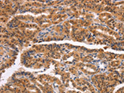 The image on the left is immunohistochemistry of paraffin-embedded Human thyroid cancer tissue using CSB-PA572077(NCAPG2 Antibody) at dilution 1/50, on the right is treated with synthetic peptide. (Original magnification: ×200)