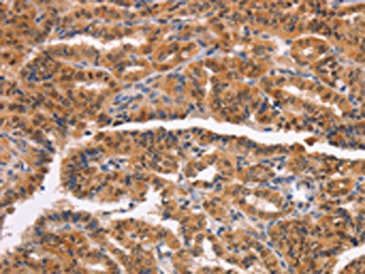 The image on the left is immunohistochemistry of paraffin-embedded Human thyroid cancer tissue using CSB-PA572077(NCAPG2 Antibody) at dilution 1/50, on the right is treated with synthetic peptide. (Original magnification: ×200)