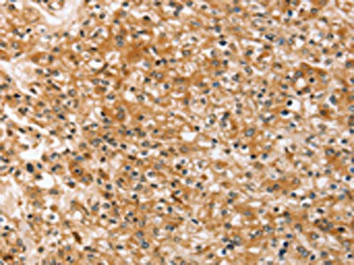 The image on the left is immunohistochemistry of paraffin-embedded Human prostate cancer tissue using CSB-PA572147(SLC40A1 Antibody) at dilution 1/20, on the right is treated with synthetic peptide. (Original magnification: ×200)