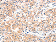 The image on the left is immunohistochemistry of paraffin-embedded Human ovarian cancer tissue using CSB-PA572200(MUC2 Antibody) at dilution 1/60, on the right is treated with synthetic peptide. (Original magnification: ×200)