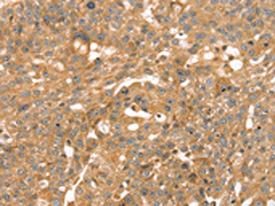The image on the left is immunohistochemistry of paraffin-embedded Human breast cancer tissue using CSB-PA572337(TRIM45 Antibody) at dilution 1/45, on the right is treated with synthetic peptide. (Original magnification: ×200)