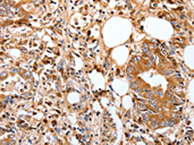 The image on the left is immunohistochemistry of paraffin-embedded Human stomach cancer tissue using CSB-PA572384(FOXO3 Antibody) at dilution 1/17, on the right is treated with synthetic peptide. (Original magnification: ×200)