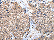 The image on the left is immunohistochemistry of paraffin-embedded Human breast cancer tissue using CSB-PA572404(CTBP1 Antibody) at dilution 1/65, on the right is treated with synthetic peptide. (Original magnification: ×200)