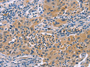 The image on the left is immunohistochemistry of paraffin-embedded Human lung cancer tissue using CSB-PA572418(IRF3 Antibody) at dilution 1/30, on the right is treated with fusion protein. (Original magnification: ×200)