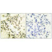 Immunohistochemical analysis of paraffin-embedded human breast carcinoma tissue using DNA-PK antibody.