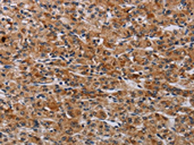 The image on the left is immunohistochemistry of paraffin-embedded Human prostate cancer tissue using CSB-PA572574(F2RL2 Antibody) at dilution 1/30, on the right is treated with synthetic peptide. (Original magnification: ×200)