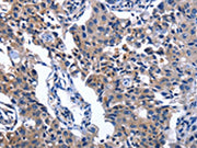 The image on the left is immunohistochemistry of paraffin-embedded Human lung cancer tissue using CSB-PA572641(NAT8 Antibody) at dilution 1/50, on the right is treated with fusion protein. (Original magnification: ×200)