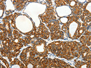 The image on the left is immunohistochemistry of paraffin-embedded Human thyroid cancer tissue using CSB-PA572733(SLC12A4 Antibody) at dilution 1/30, on the right is treated with fusion protein. (Original magnification: ×200)