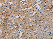 The image on the left is immunohistochemistry of paraffin-embedded Human prostate cancer tissue using CSB-PA572789(PHKA2 Antibody) at dilution 1/30, on the right is treated with synthetic peptide. (Original magnification: ×200)