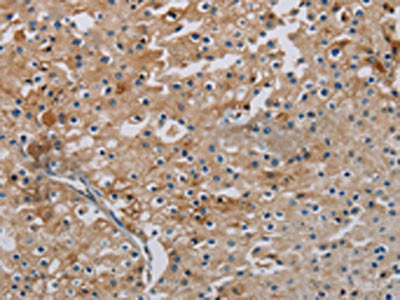 The image on the left is immunohistochemistry of paraffin-embedded Human prostate cancer tissue using CSB-PA572789(PHKA2 Antibody) at dilution 1/30, on the right is treated with synthetic peptide. (Original magnification: ×200)
