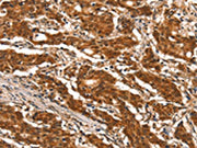 The image on the left is immunohistochemistry of paraffin-embedded Human gastic cancer tissue using CSB-PA572968(DDX4 Antibody) at dilution 1/25, on the right is treated with synthetic peptide. (Original magnification: ×200)