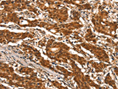The image on the left is immunohistochemistry of paraffin-embedded Human gastic cancer tissue using CSB-PA572968(DDX4 Antibody) at dilution 1/25, on the right is treated with synthetic peptide. (Original magnification: ×200)