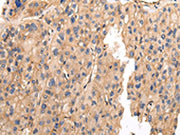 The image on the left is immunohistochemistry of paraffin-embedded Human liver cancer tissue using CSB-PA573280(VAMP5 Antibody) at dilution 1/25, on the right is treated with fusion protein. (Original magnification: ×200)