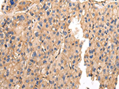 The image on the left is immunohistochemistry of paraffin-embedded Human liver cancer tissue using CSB-PA573280(VAMP5 Antibody) at dilution 1/25, on the right is treated with fusion protein. (Original magnification: ×200)