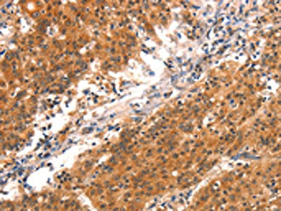 The image on the left is immunohistochemistry of paraffin-embedded Human gastic cancer tissue using CSB-PA573522(BCL3 Antibody) at dilution 1/15, on the right is treated with synthetic peptide. (Original magnification: ×200)