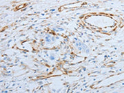 The image on the left is immunohistochemistry of paraffin-embedded Human esophagus cancer tissue using CSB-PA573580(SPINT1 Antibody) at dilution 1/25, on the right is treated with fusion protein. (Original magnification: ×200)