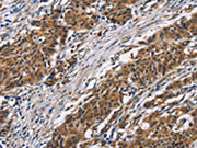 The image on the left is immunohistochemistry of paraffin-embedded Human gastic cancer tissue using CSB-PA573955(ARSB Antibody) at dilution 1/50, on the right is treated with synthetic peptide. (Original magnification: ×200)