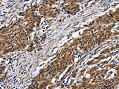The image on the left is immunohistochemistry of paraffin-embedded Human gastic cancer tissue using CSB-PA573955(ARSB Antibody) at dilution 1/50, on the right is treated with synthetic peptide. (Original magnification: ×200)
