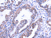 The image on the left is immunohistochemistry of paraffin-embedded Human esophagus cancer tissue using CSB-PA574019(THRSP Antibody) at dilution 1/25, on the right is treated with fusion protein. (Original magnification: ×200)