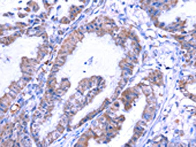 The image on the left is immunohistochemistry of paraffin-embedded Human esophagus cancer tissue using CSB-PA574019(THRSP Antibody) at dilution 1/25, on the right is treated with fusion protein. (Original magnification: ×200)