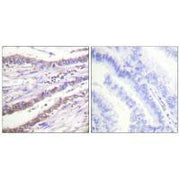 Immunohistochemical analysis of paraffin-embedded human lung carcinoma tissue using Cyclin A antibody.