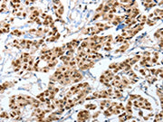 The image on the left is immunohistochemistry of paraffin-embedded Human breast cancer tissue using CSB-PA574741(ANXA10 Antibody) at dilution 1/35, on the right is treated with fusion protein. (Original magnification: ×200)