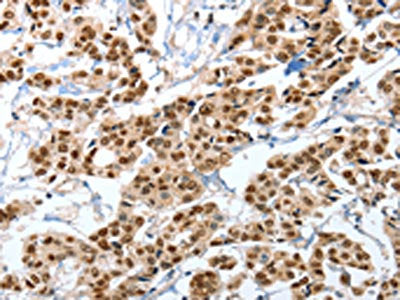The image on the left is immunohistochemistry of paraffin-embedded Human breast cancer tissue using CSB-PA574741(ANXA10 Antibody) at dilution 1/35, on the right is treated with fusion protein. (Original magnification: ×200)