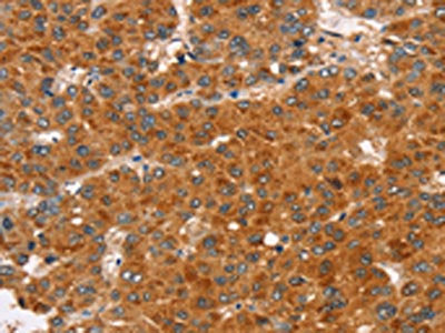 The image on the left is immunohistochemistry of paraffin-embedded Human liver cancer tissue using CSB-PA574803(RASA3 Antibody) at dilution 1/35, on the right is treated with synthetic peptide. (Original magnification: ×200)