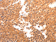The image on the left is immunohistochemistry of paraffin-embedded Human breast cancer tissue using CSB-PA574868(BDKRB2 Antibody) at dilution 1/30, on the right is treated with synthetic peptide. (Original magnification: ×200)