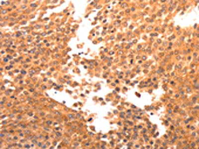 The image on the left is immunohistochemistry of paraffin-embedded Human breast cancer tissue using CSB-PA574868(BDKRB2 Antibody) at dilution 1/30, on the right is treated with synthetic peptide. (Original magnification: ×200)