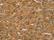 The image on the left is immunohistochemistry of paraffin-embedded Human liver cancer tissue using CSB-PA575003(SPTAN1 Antibody) at dilution 1/30, on the right is treated with synthetic peptide. (Original magnification: ×200)