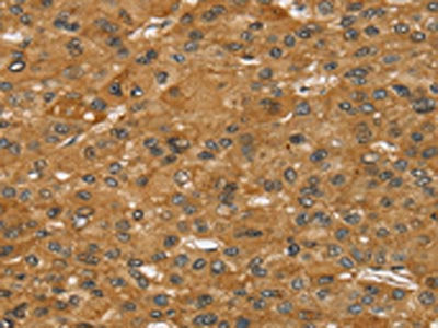 The image on the left is immunohistochemistry of paraffin-embedded Human liver cancer tissue using CSB-PA575003(SPTAN1 Antibody) at dilution 1/30, on the right is treated with synthetic peptide. (Original magnification: ×200)