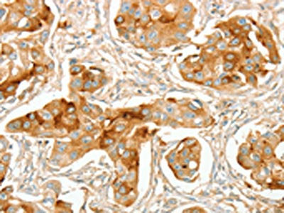 The image on the left is immunohistochemistry of paraffin-embedded Human breast cancer tissue using CSB-PA575032(ACE Antibody) at dilution 1/70, on the right is treated with synthetic peptide. (Original magnification: ×200)