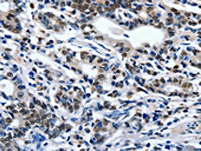 The image on the left is immunohistochemistry of paraffin-embedded Human gastic cancer tissue using CSB-PA575380(ENPP3 Antibody) at dilution 1/80, on the right is treated with synthetic peptide. (Original magnification: ×200)