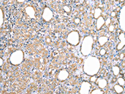 The image on the left is immunohistochemistry of paraffin-embedded Human thyroid cancer tissue using CSB-PA575431(VAPA Antibody) at dilution 1/35, on the right is treated with fusion protein. (Original magnification: ×200)