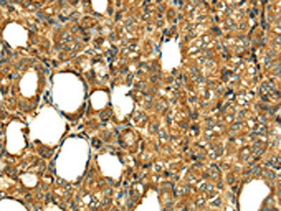 The image on the left is immunohistochemistry of paraffin-embedded Human thyroid cancer tissue using CSB-PA575497(RLN1 Antibody) at dilution 1/20, on the right is treated with fusion protein. (Original magnification: ×200)