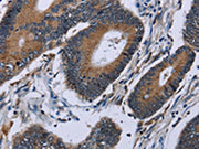 The image on the left is immunohistochemistry of paraffin-embedded Human colon cancer tissue using CSB-PA575590(IPO4 Antibody) at dilution 1/50, on the right is treated with fusion protein. (Original magnification: ×200)