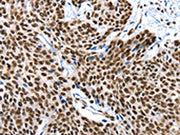 The image on the left is immunohistochemistry of paraffin-embedded Human esophagus cancer tissue using CSB-PA575804(XRCC6 Antibody) at dilution 1/10, on the right is treated with fusion protein. (Original magnification: ×200)