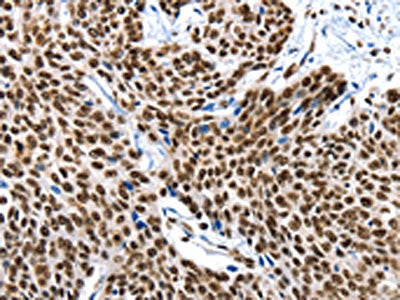 The image on the left is immunohistochemistry of paraffin-embedded Human esophagus cancer tissue using CSB-PA575804(XRCC6 Antibody) at dilution 1/10, on the right is treated with fusion protein. (Original magnification: ×200)