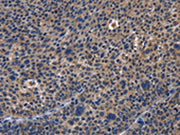 The image on the left is immunohistochemistry of paraffin-embedded Human liver cancer tissue using CSB-PA575950(PRKCD Antibody) at dilution 1/30, on the right is treated with fusion protein. (Original magnification: ×200)