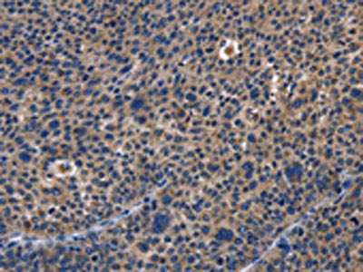 The image on the left is immunohistochemistry of paraffin-embedded Human liver cancer tissue using CSB-PA575950(PRKCD Antibody) at dilution 1/30, on the right is treated with fusion protein. (Original magnification: ×200)