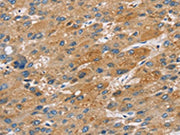 The image on the left is immunohistochemistry of paraffin-embedded Human liver cancer tissue using CSB-PA575960(ST18 Antibody) at dilution 1/50, on the right is treated with fusion protein. (Original magnification: ×200)