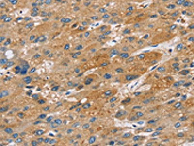 The image on the left is immunohistochemistry of paraffin-embedded Human liver cancer tissue using CSB-PA575960(ST18 Antibody) at dilution 1/50, on the right is treated with fusion protein. (Original magnification: ×200)