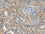 The image on the left is immunohistochemistry of paraffin-embedded Human ovarian cancer tissue using CSB-PA576070(P2RY6 Antibody) at dilution 1/40, on the right is treated with synthetic peptide. (Original magnification: ×200)