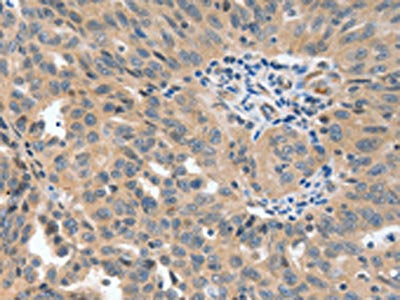The image on the left is immunohistochemistry of paraffin-embedded Human ovarian cancer tissue using CSB-PA576070(P2RY6 Antibody) at dilution 1/40, on the right is treated with synthetic peptide. (Original magnification: ×200)